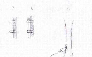Quick Snare Securing Methods Fox Snare Quick Anchor